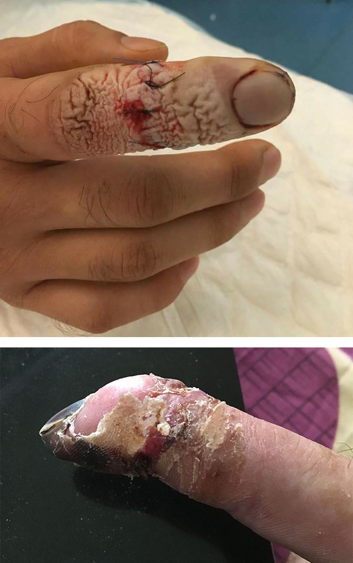 skadet finger